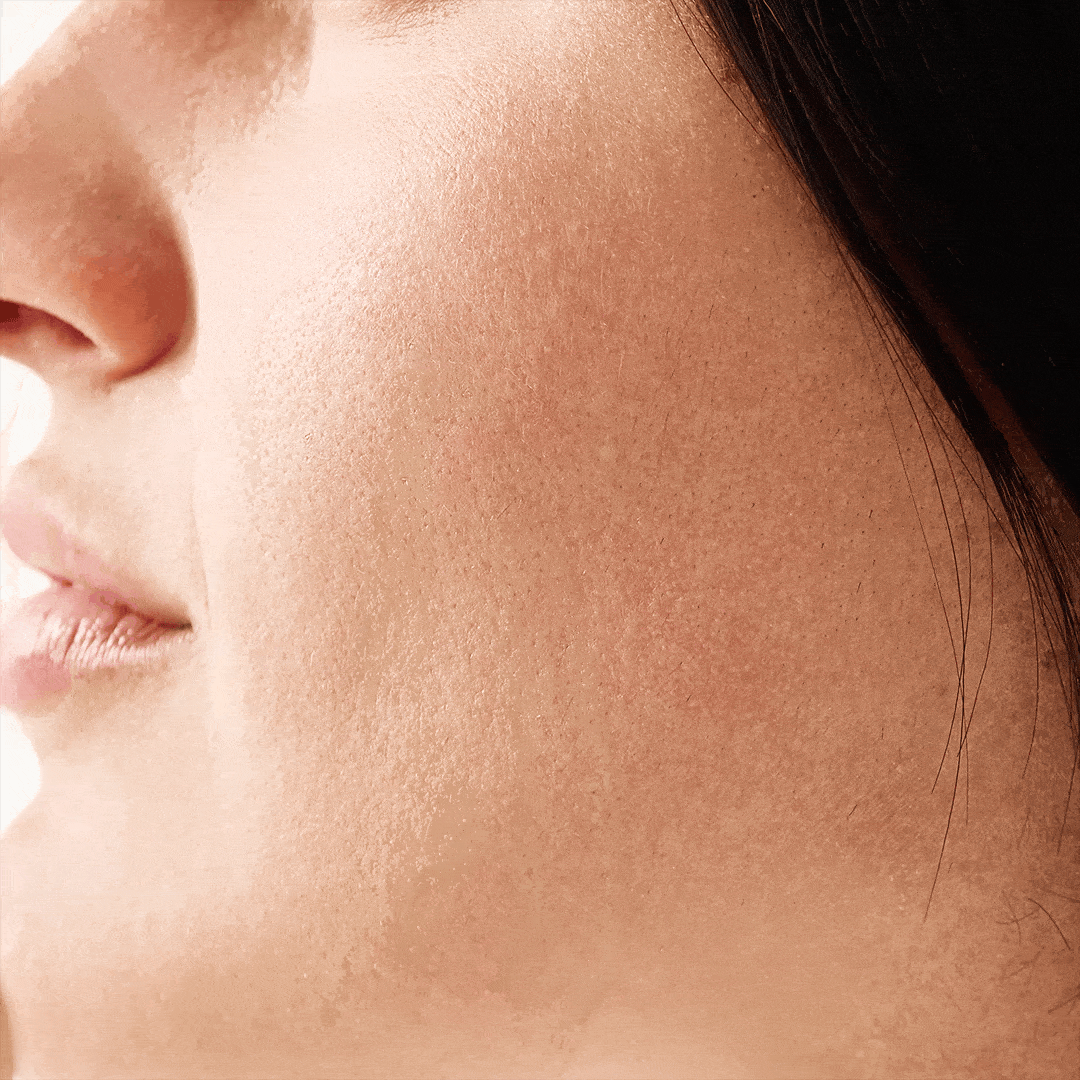 How to Use Pimple Patches Like an Expert