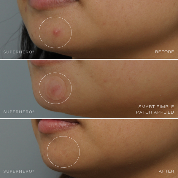 Bromance® Smart Pimple Patch