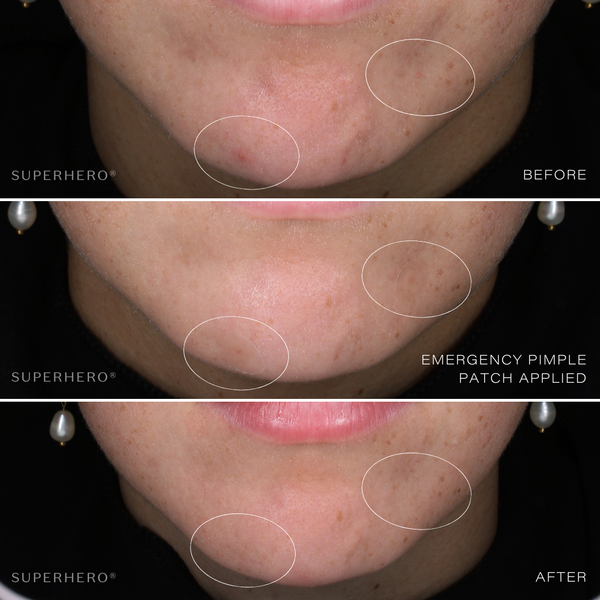 Bromance® Emergency Pimple Patch